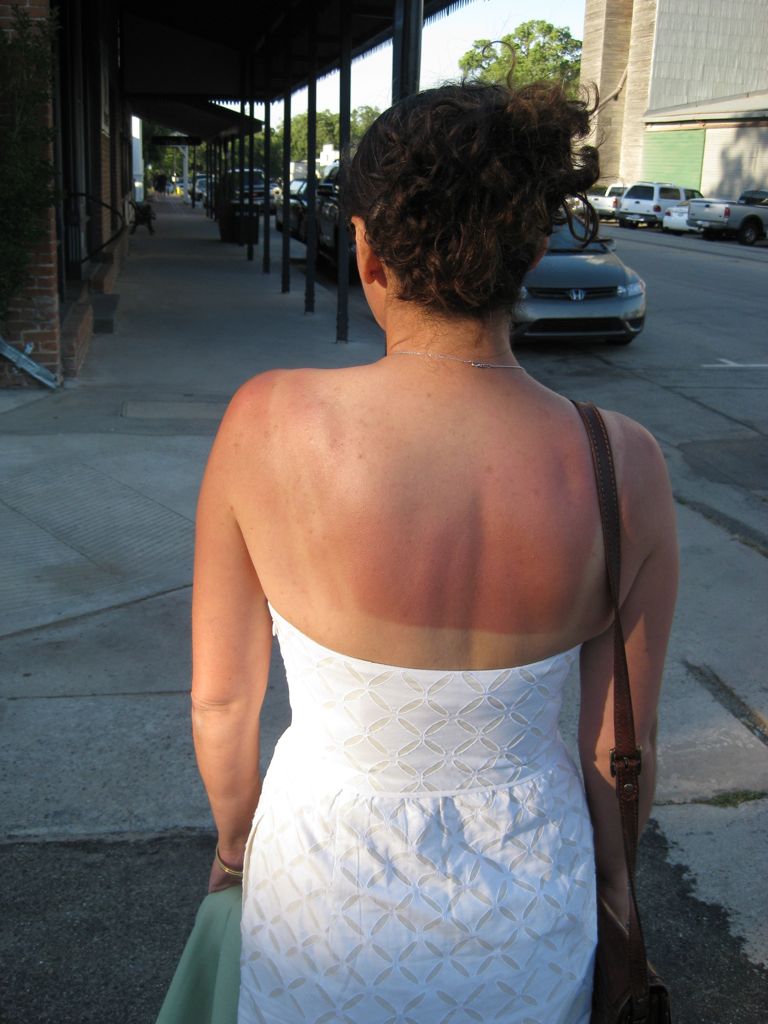 With a bottling burn/